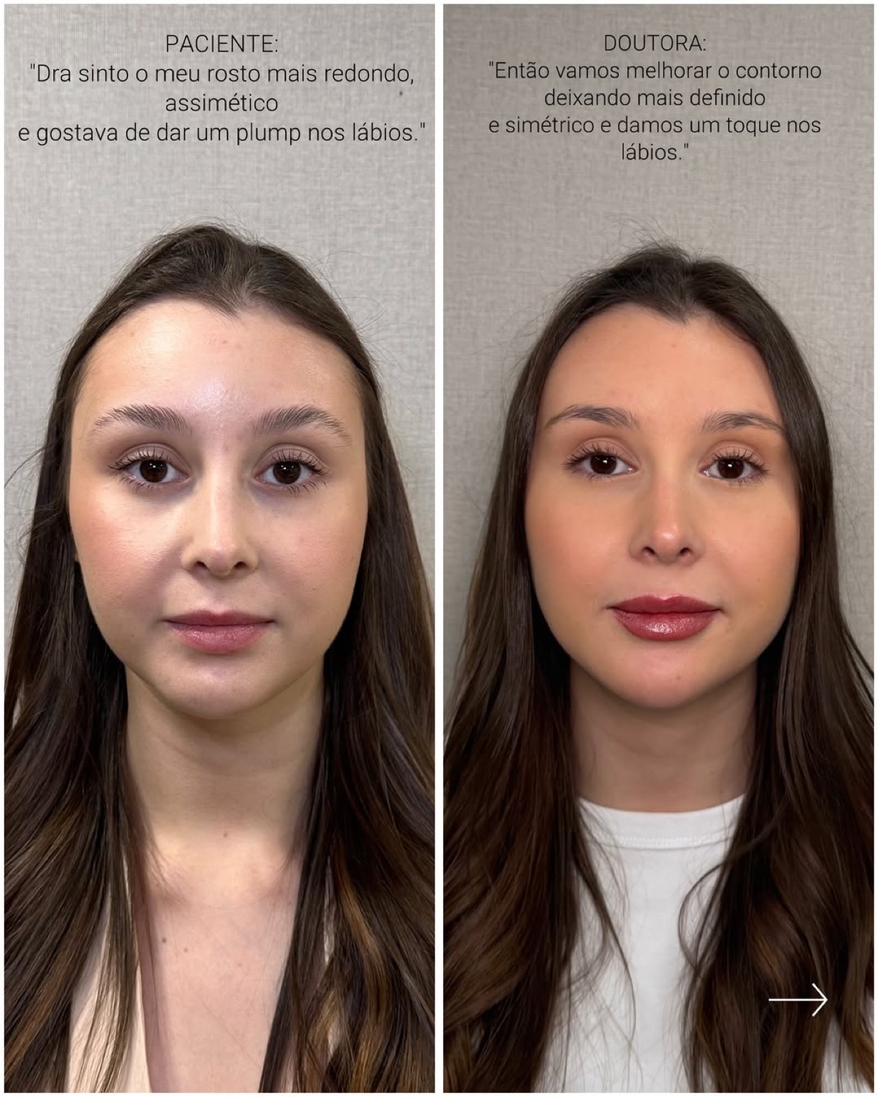 Antes e depois de harmonização facial