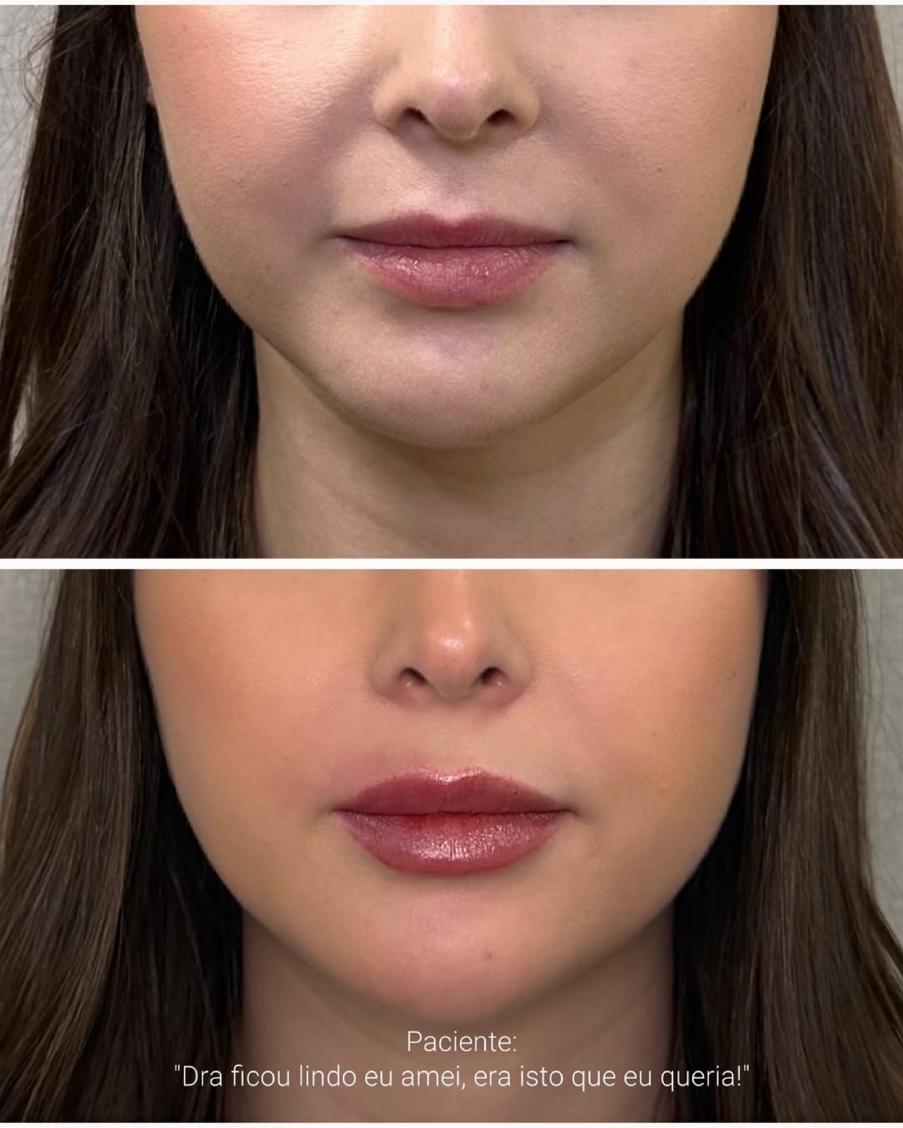 Antes e depois de harmonização facial